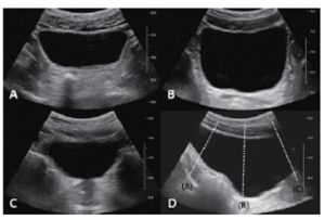 신장 및 방광 11.jpg