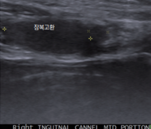 잠복고환2.png