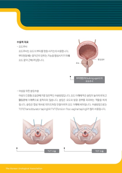 파일:긴장형 요실금.pdf