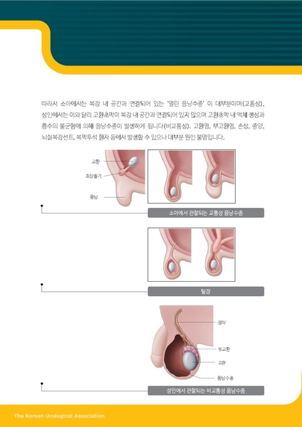 파일:소아 음낭수종.pdf