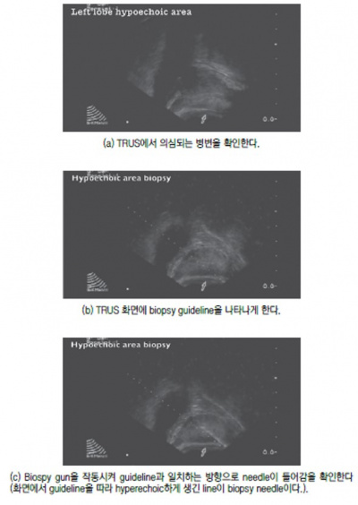 전립선 18.jpg