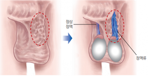 정계정맥류1.png